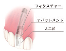 インプラントとは